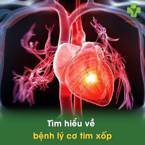 Tìm hiểu về bệnh lý cơ tim xốp