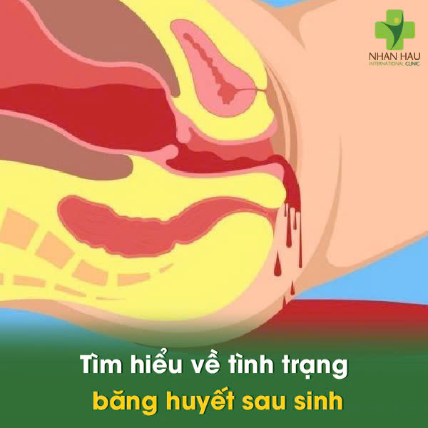 Tìm hiểu về tình trạng băng huyết sau sinh