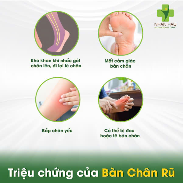 Triệu chứng của Bàn Chân Rũ