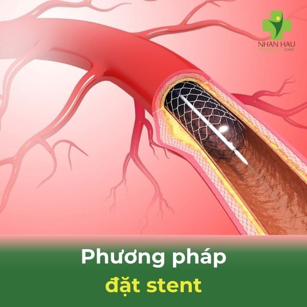 phương pháp đặt stent