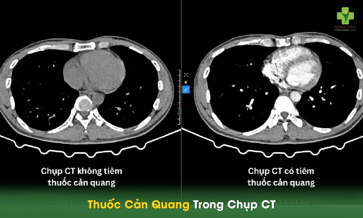 Chụp CT Có Cản Quang: Hướng Dẫn Toàn Diện Từ Chuyên Gia 4 Thuốc Cản Quang Trong Chụp CT