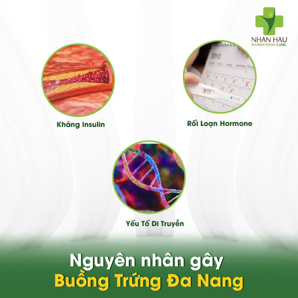 Buồng Trứng Đa Nang: Hiểu Rõ Triệu Chứng, Buồng Trứng Đa Nang: Hiểu Rõ Triệu Chứng 2 Nguyên nhân gây Buồng Trứng Đa Nang