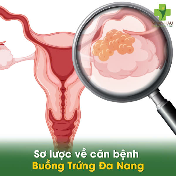Sơ lược về căn bệnh Buồng Trứng Đa Nang