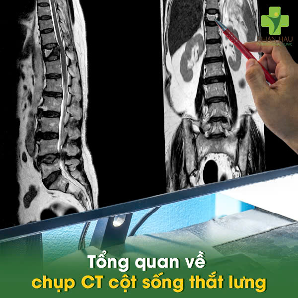 Chụp CT Cột Sống Thắt Lưng: Chi Phí, Quy Trình, Và Những Điều Cần Biết 1 Tổng quan về chụp CT cột sống thắt lưng