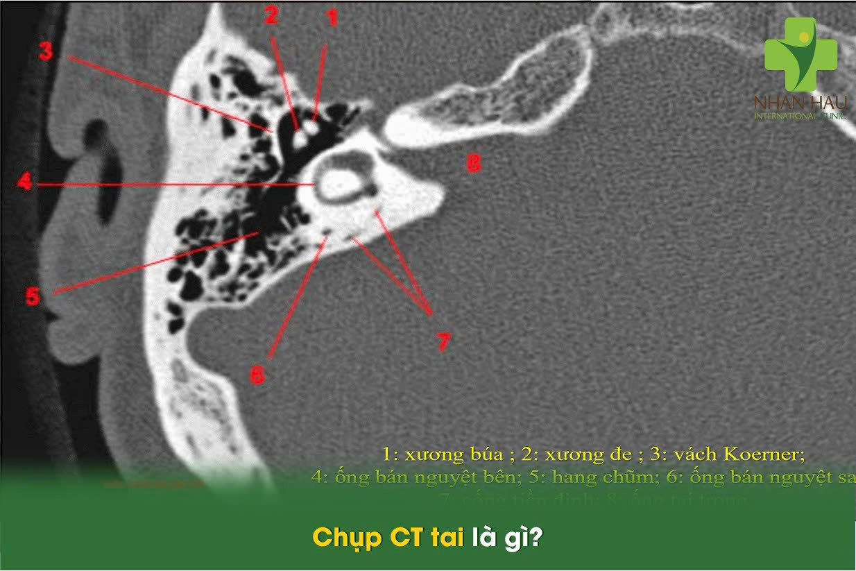 Chụp CT tai: Phương pháp chẩn đoán chính xác bệnh lý tai mũi họng 1 Chụp CT tai là gì?