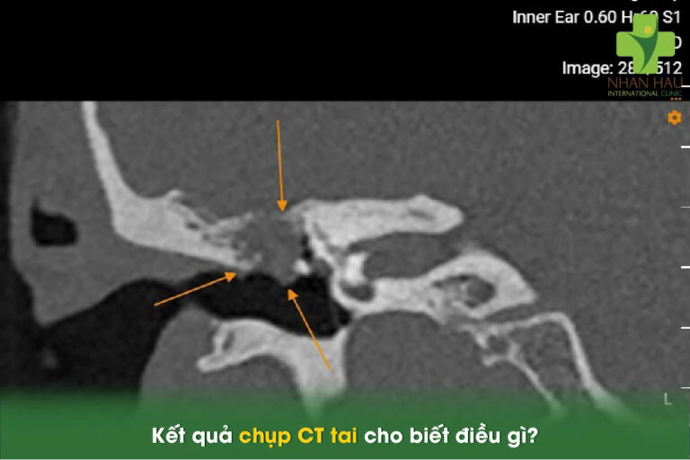 Kết quả chụp CT tai cho biết điều gì?