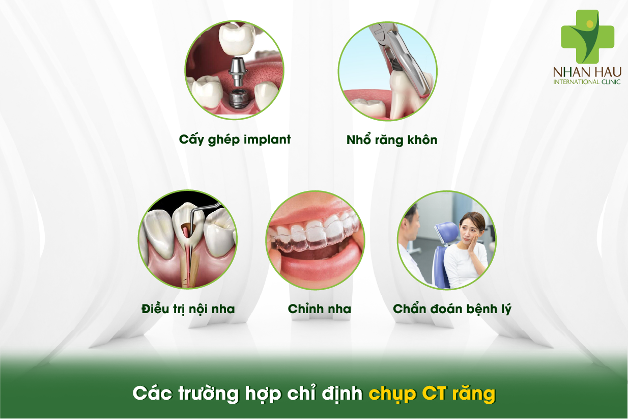 Các trường hợp chỉ định chụp CT răng