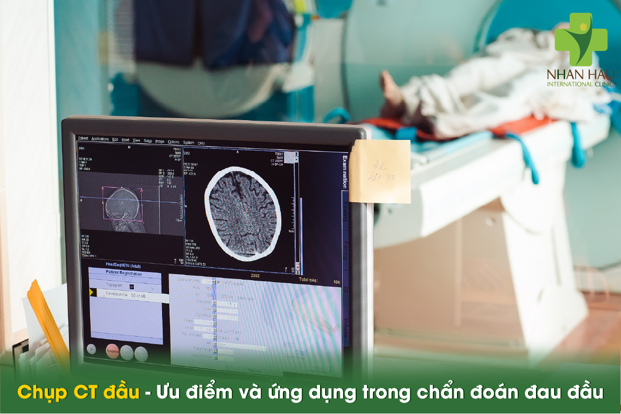 Đau đầu nên chụp CT hay MRI? Bác sĩ hướng dẫn chọn đúng phương pháp 2 Chụp CT đầu - Ưu điểm và ứng dụng trong chẩn đoán đau đầu