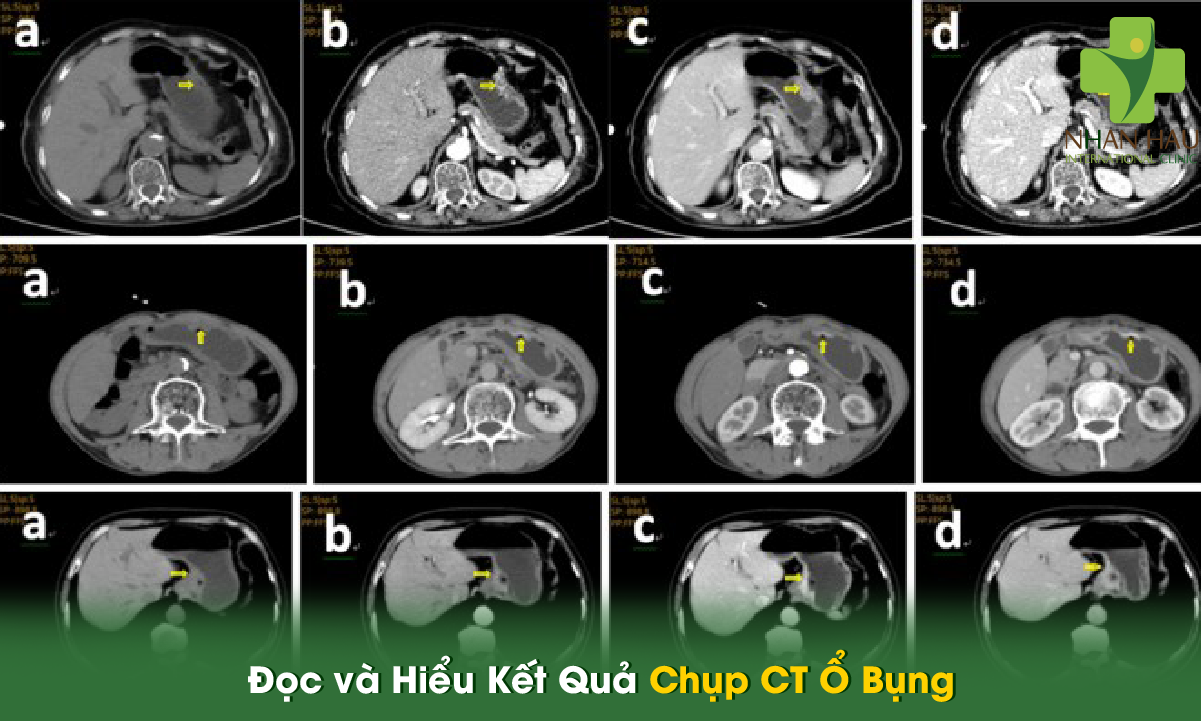 Chụp CT Ổ Bụng: Quy Trình, Chỉ Định và Những Điều Cần Biết 5 Đọc và Hiểu Kết Quả Chụp CT Ổ Bụng