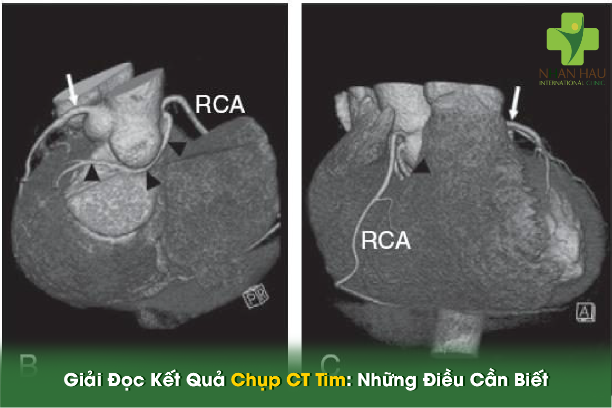 Chụp CT Tim: Phương Pháp Chẩn Đoán Tim Mạch Hiện Đại Và Hiệu Quả 6 Giải Đọc Kết Quả Chụp CT Tim: Những Điều Cần Biết