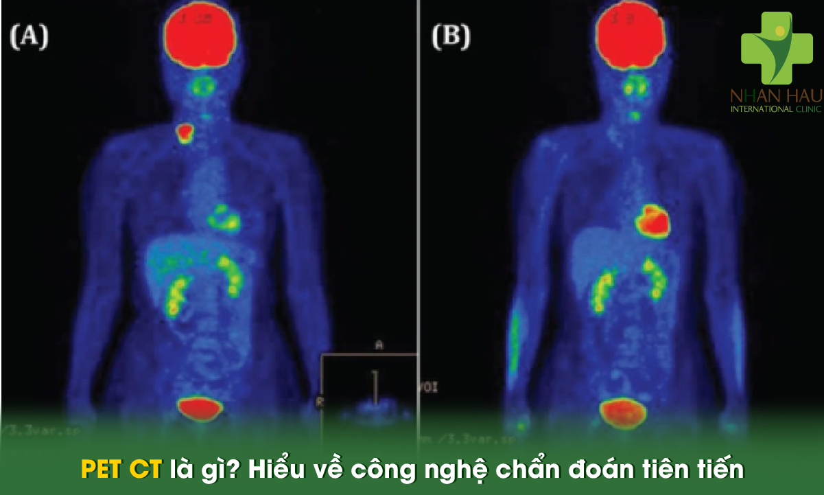 PET CT là gì? Hiểu về công nghệ chẩn đoán tiên tiến