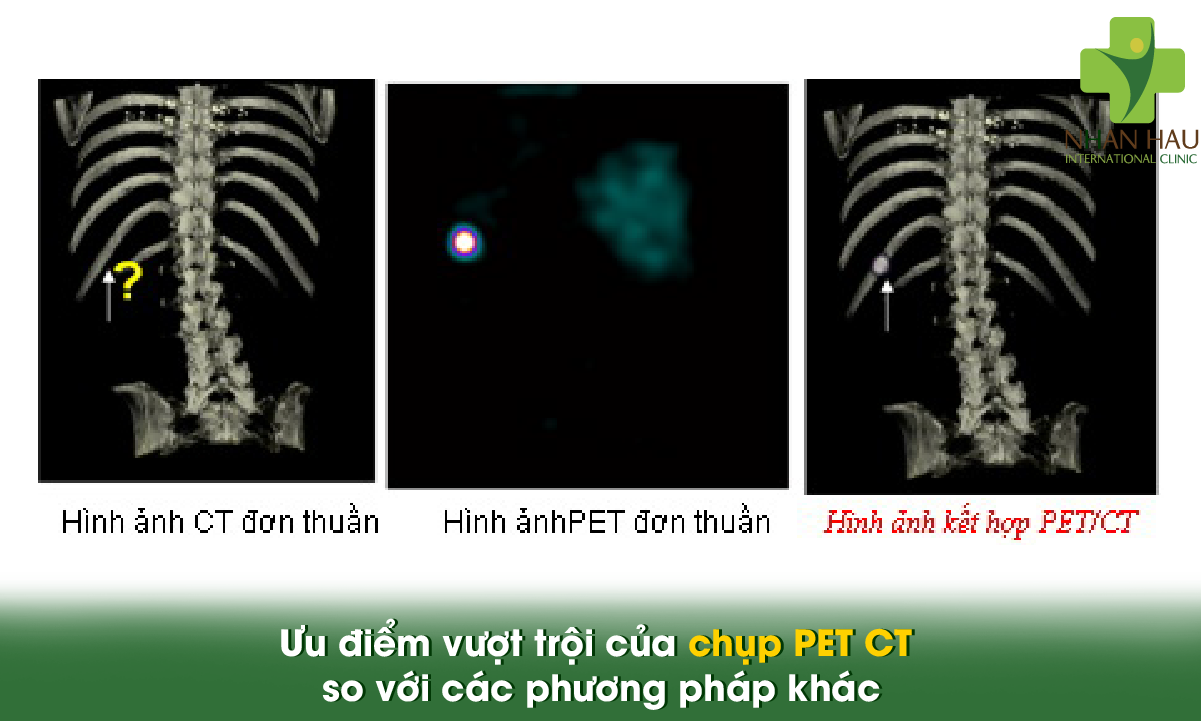 Chụp PET CT là gì? Tìm hiểu toàn bộ về kỹ thuật chẩn đoán hiện đại 2 Ưu điểm vượt trội của chụp PET CT so với các phương pháp khác