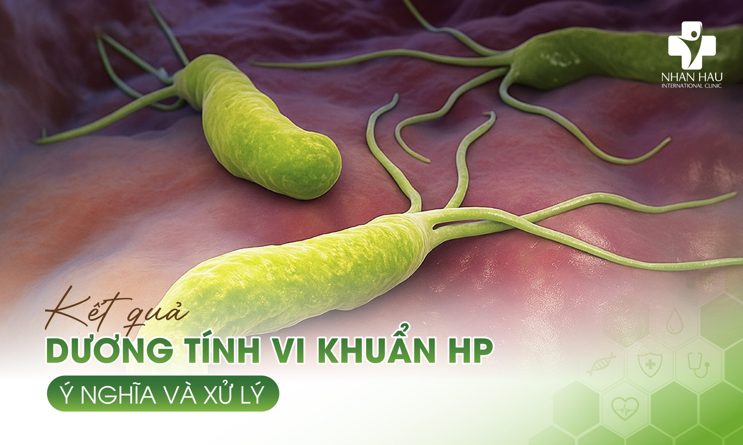 Kết Quả Dương Tính Vi Khuẩn HP - Ý Nghĩa và Xử Lý
