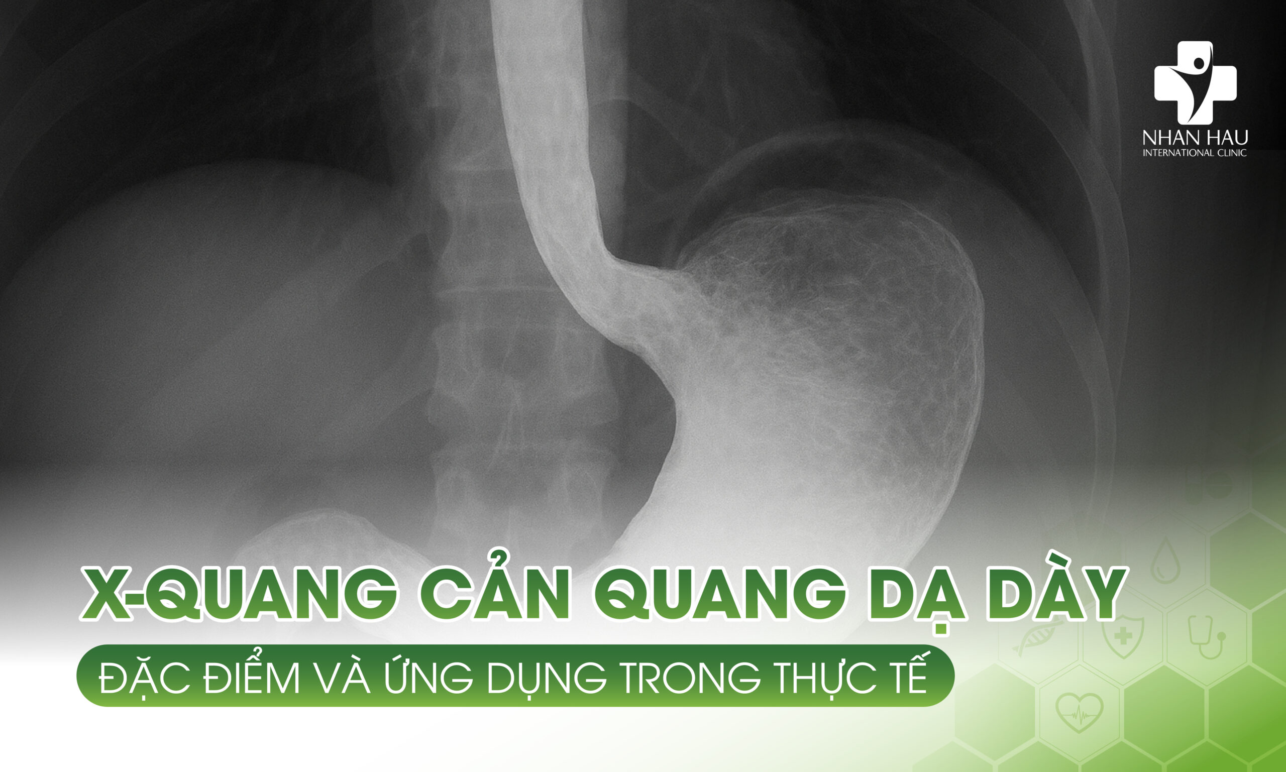 So sánh nội soi dạ dày, X-quang và siêu âm bụng: Hiểu rõ từng phương pháp chẩn đoán 3 X-quang cản quang dạ dày: Đặc điểm và ứng dụng trong thực tế