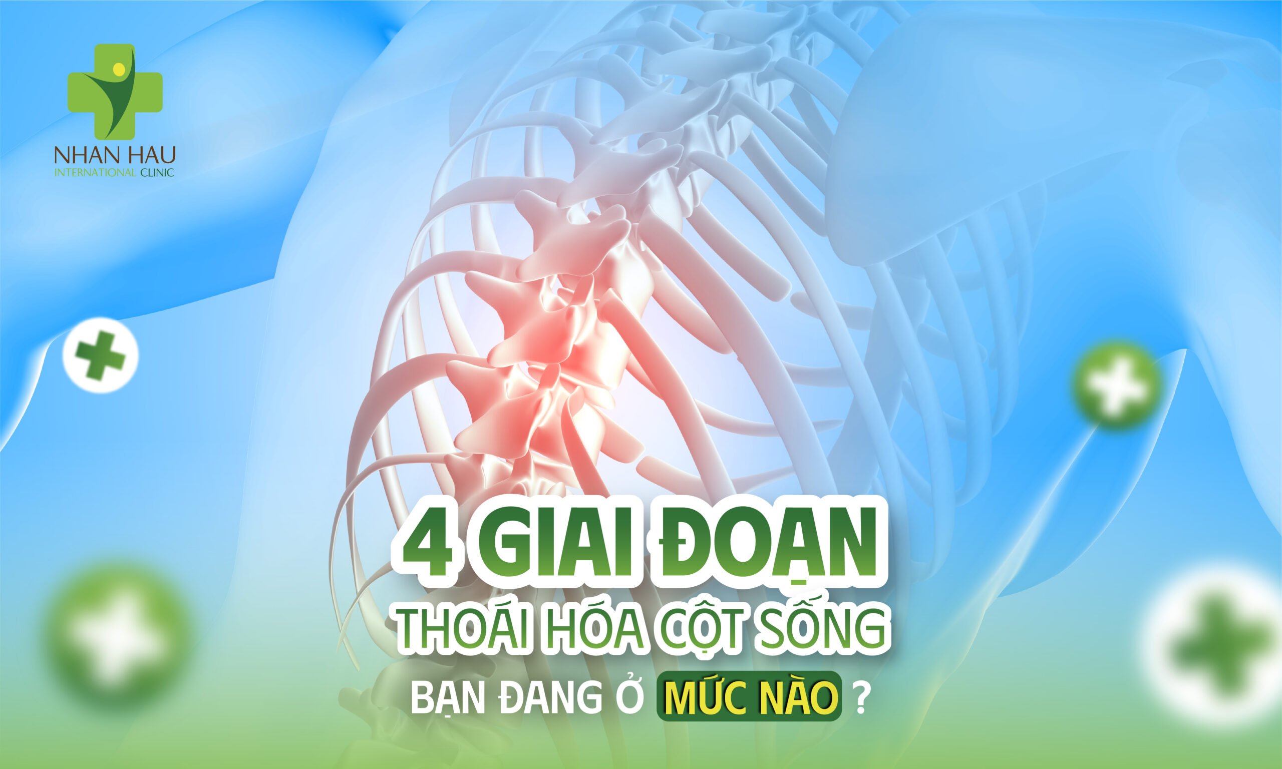4 Giai Đoạn Thoái Hóa Cột Sống — Bạn Đang Ở Mức Nào?