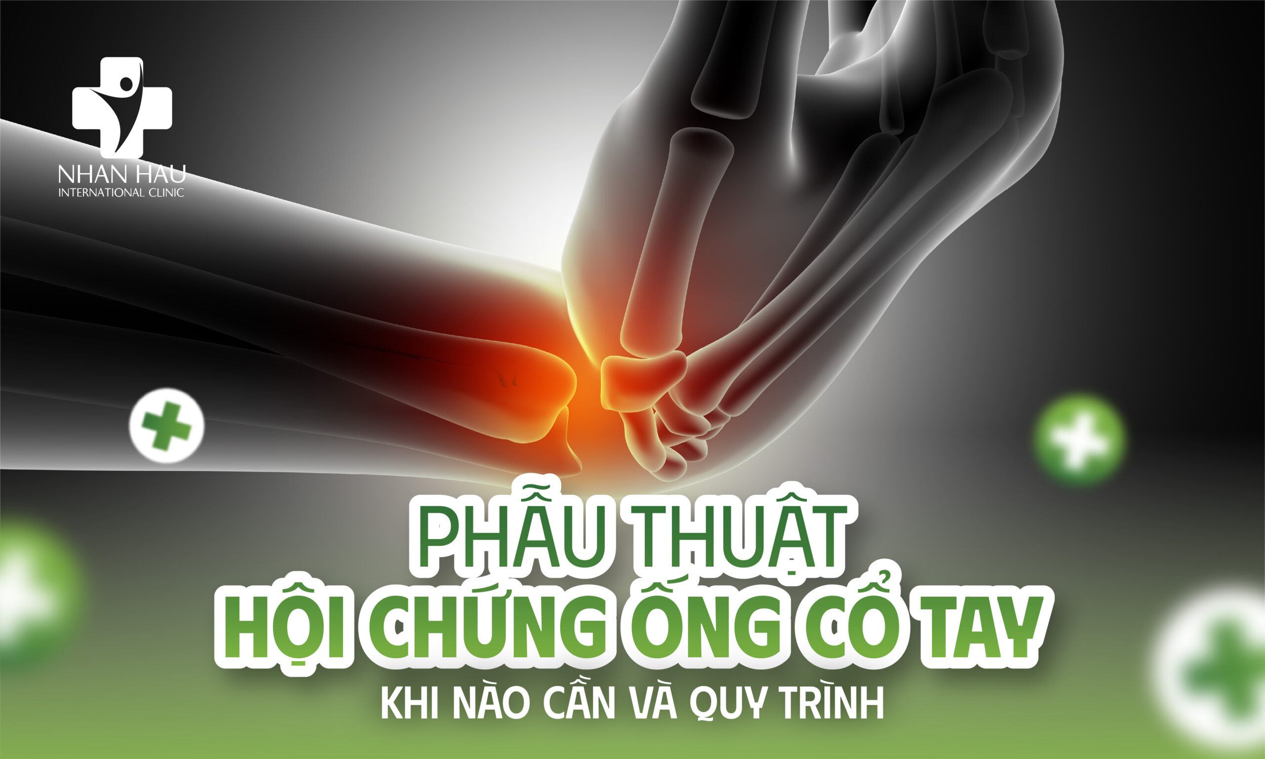Phẫu Thuật Hội Chứng Ống Cổ Tay — Khi Nào Cần và Quy Trình