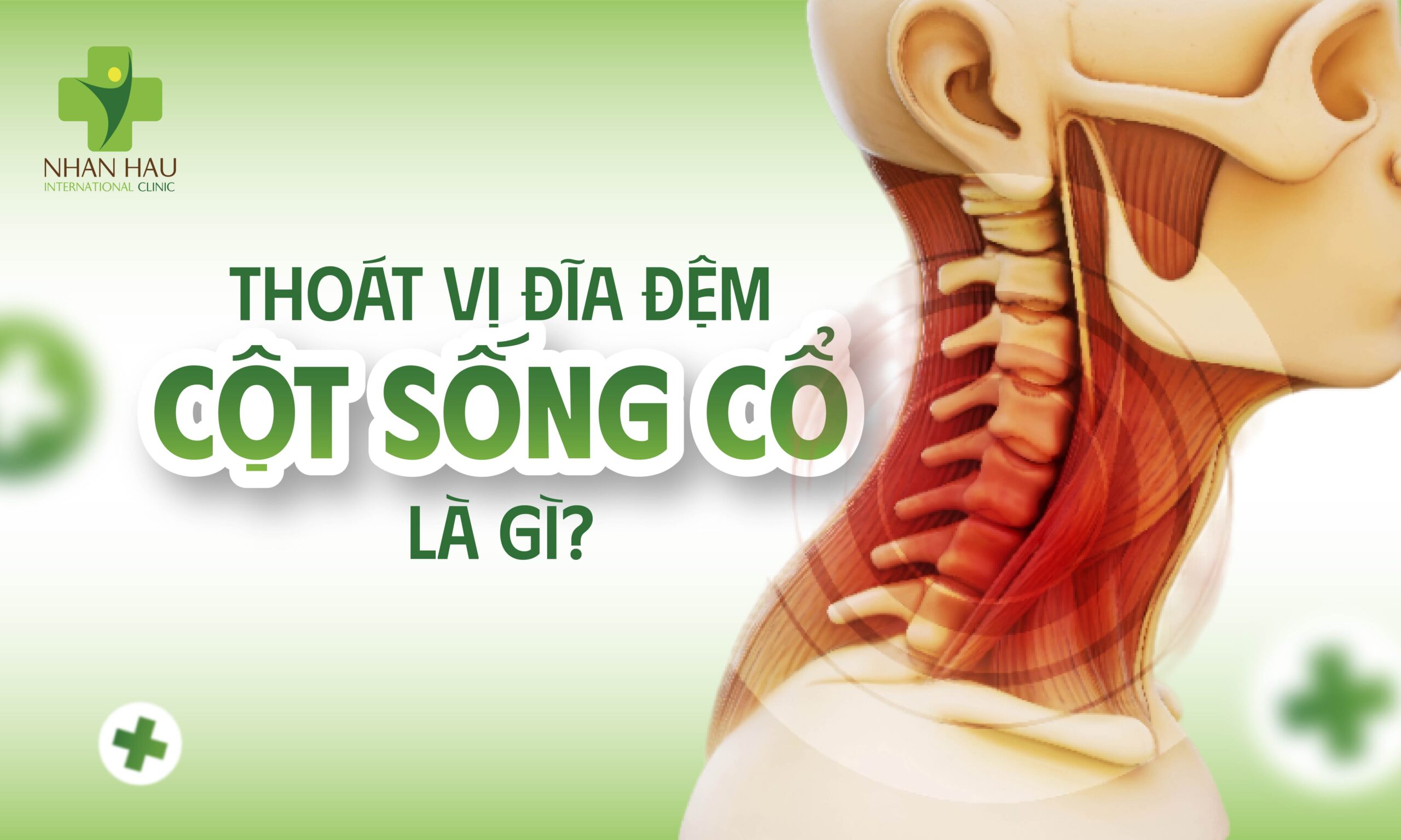 Thoát Vị Đĩa Đệm Cột Sống Cổ Là Gì?