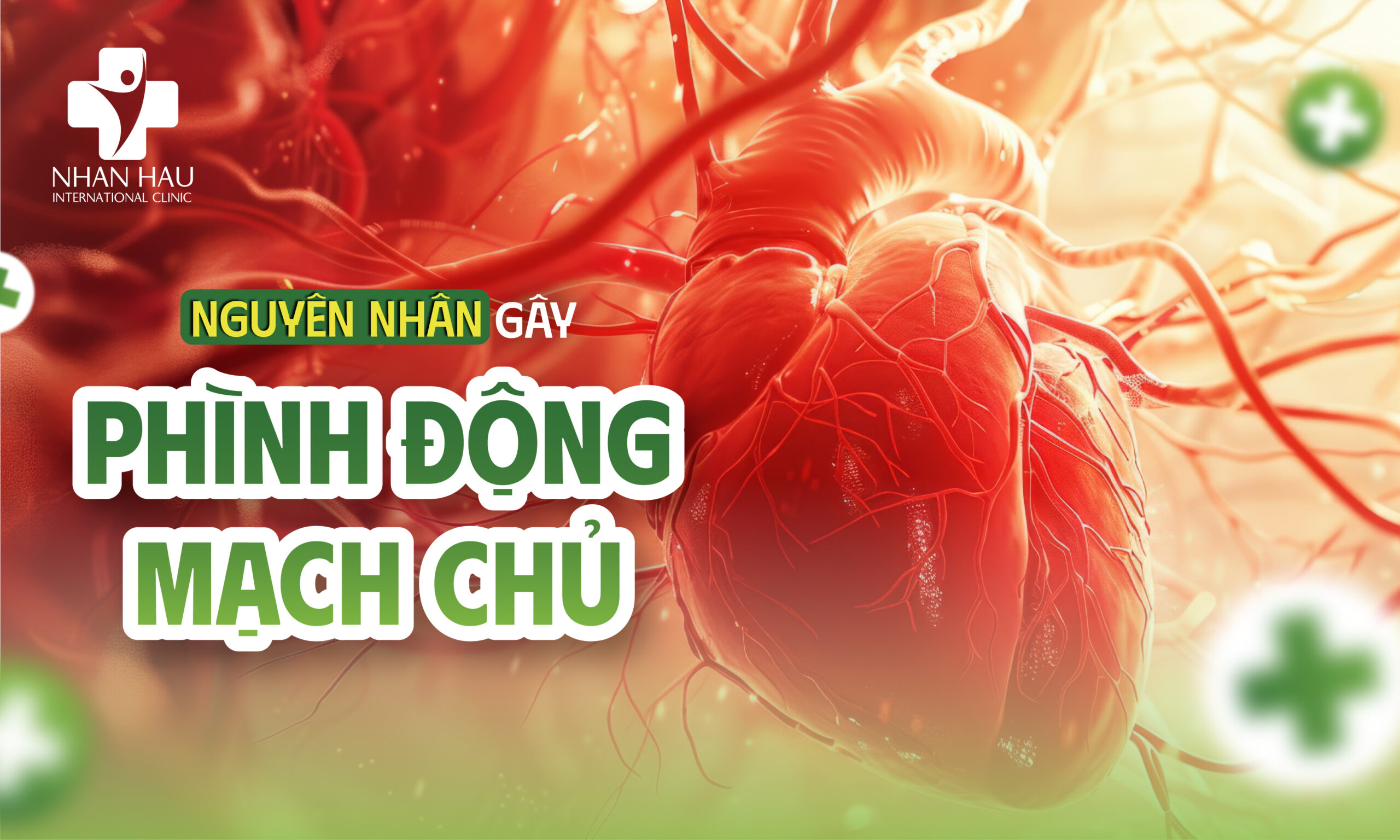 Bệnh Phình Động Mạch Chủ: Nguyên Nhân, Triệu Chứng, Chẩn Đoán và Điều Trị 2 Nguyên nhân gây Bệnh Phình Động Mạch Chủ