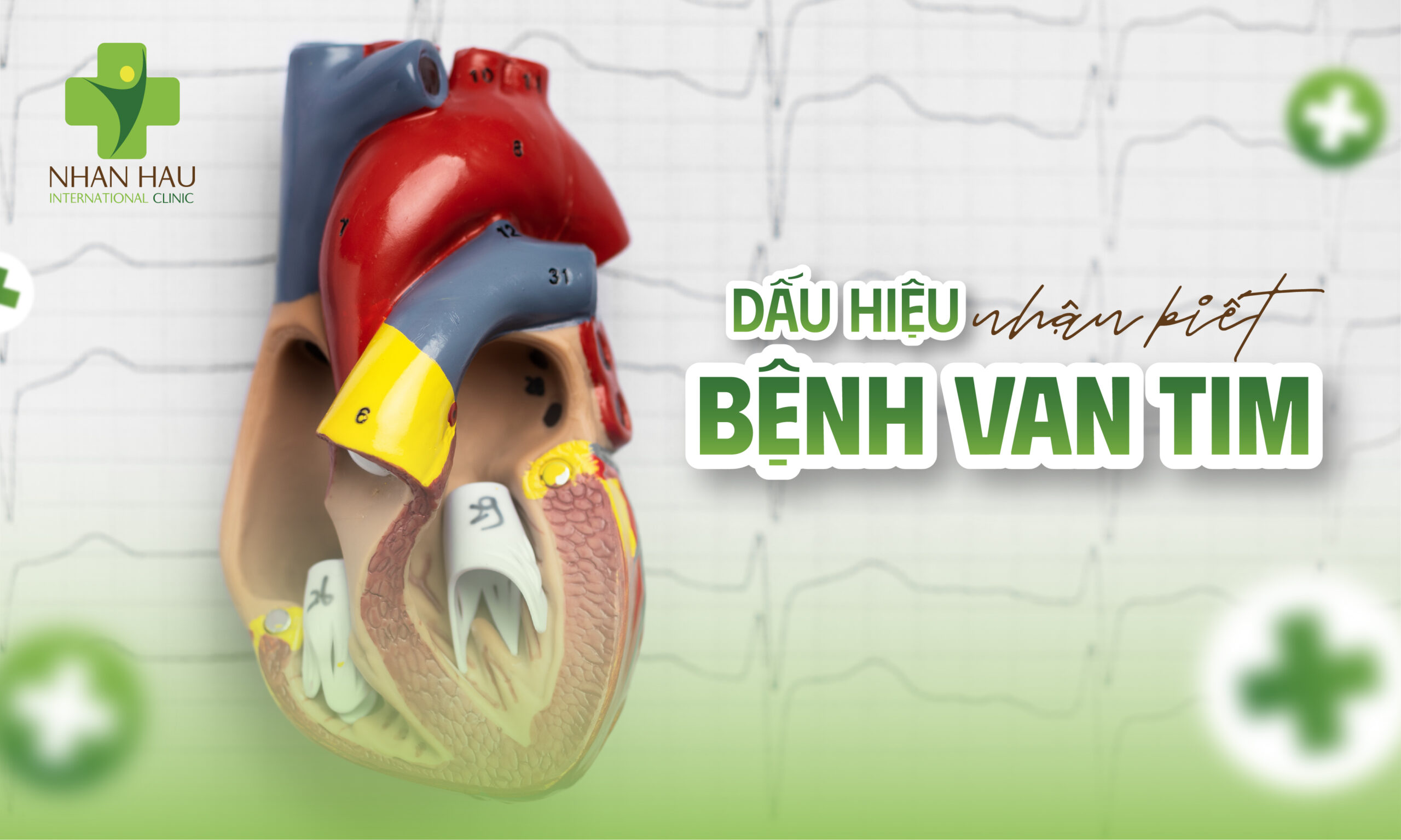 Bệnh Van Tim: Dấu Hiệu, Nguyên Nhân, Chẩn Đoán và Điều Trị 5 Dấu hiệu nhận biết bệnh van tim